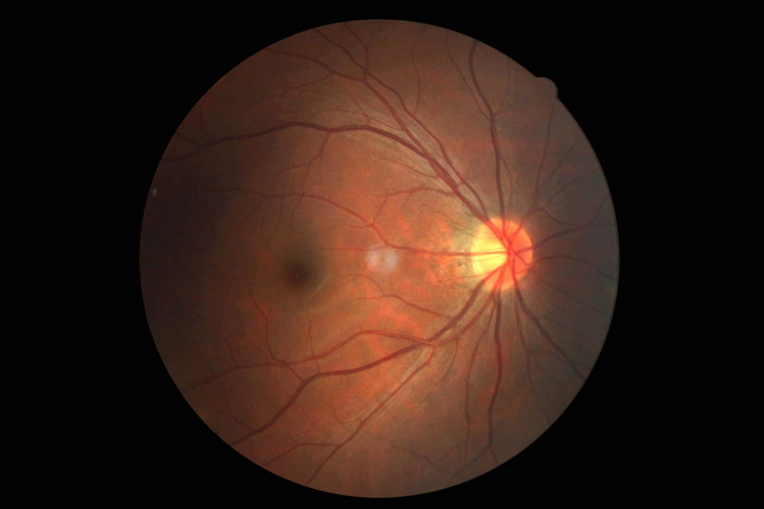 A detailed image of a human retina showing blood vessels and the optic nerve head, illuminated in varying shades of red, orange, and yellow against a dark background, appears like an auto draft of nature’s intricate design.